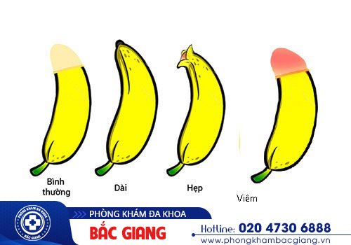 Chỉ điểm các bệnh lý bao quy đầu thường gặp, chia sẻ hướng điều trị khoa học