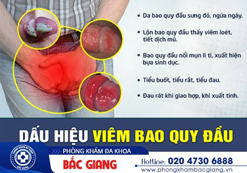 Bao quy đầu chảy mủ có nguy hiểm? Nguy cơ tiềm ẩn bệnh lý nào?