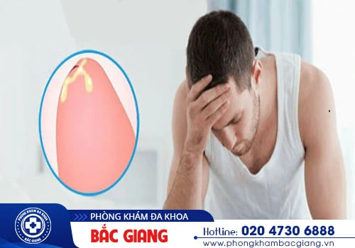 Bao quy đầu chảy mủ có nguy hiểm? Nguy cơ tiềm ẩn bệnh lý nào?
