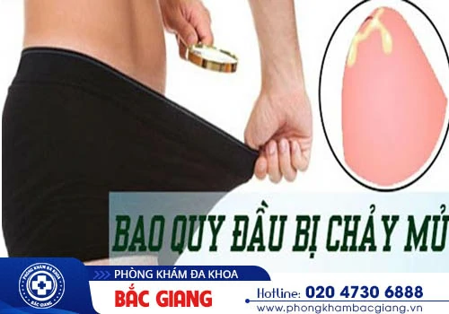 Bao quy đầu chảy mủ có nguy hiểm? Nguy cơ tiềm ẩn bệnh lý nào?