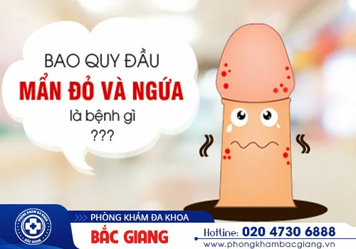 Bao quy đầu nổi mẩn đỏ - Nam giới chớ được chủ quan