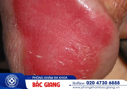 Bao quy đầu nổi mẩn đỏ - Nam giới chớ được chủ quan