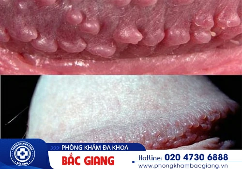 Bao quy đầu nổi mẩn đỏ - Nam giới chớ được chủ quan