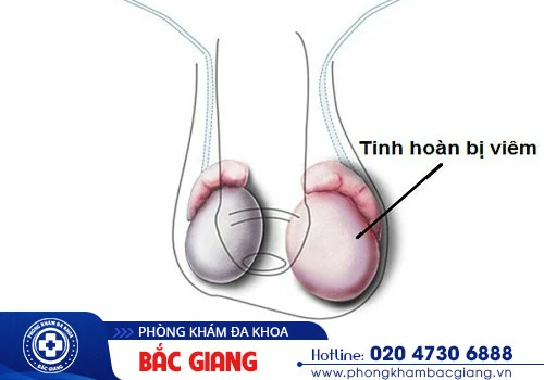 Cảnh Báo: Viêm Tinh Hoàn Phải Không Đau Nhiều Nhưng Hại Rất Sâu