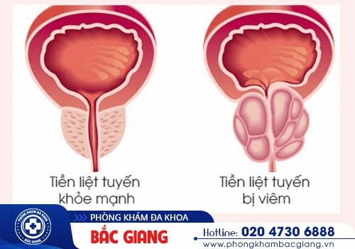 Viêm tuyến tiền liệt - Hiểu rõ để điều trị hiệu quả hơn