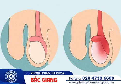 Cách trị sưng tinh hoàn như thế nào hiệu quả?
