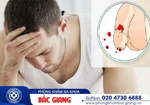 Cảnh báo triệu chứng chảy máu dương vật
