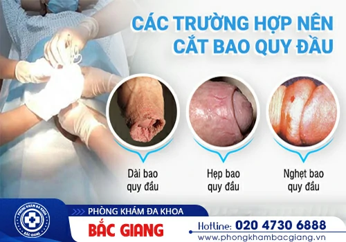 cắt bao quy đầu có ảnh hưởng gì không?