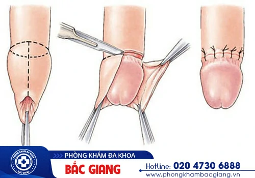 Chi phí cắt bao quy đầu bao nhiêu tiền? Những thông tin cần lưu ý