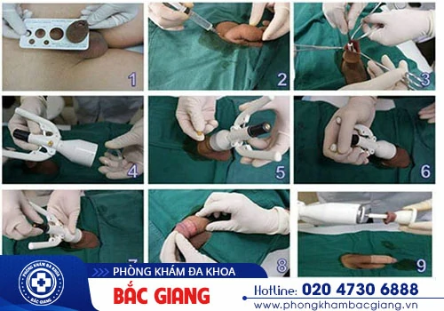Cắt bao quy đầu - Những thông tin quan trọng nam giới cần biết