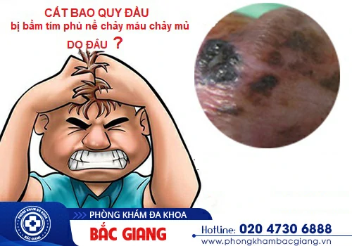 Chi phí cắt bao quy đầu bao nhiêu tiền? Những thông tin cần lưu ý