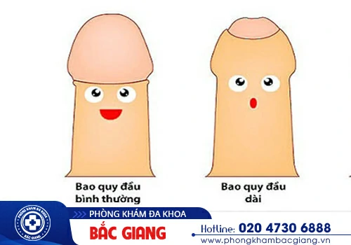 Dài bao quy đầu có sao không? Lý do mắc phải