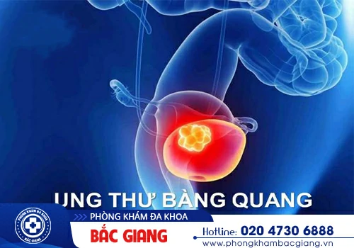 Đau bàng quang - Dấu hiệu cảnh báo sức khoẻ có vấn đề