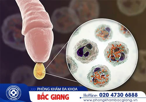 Dấu hiệu, Nguyên nhân và Cách chữa viêm bao quy đầu
