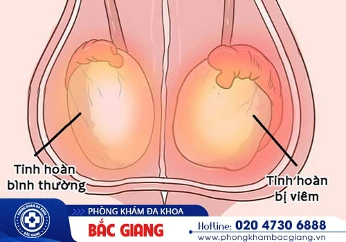 Đau tinh hoàn cảnh báo những bệnh nguy hiểm không nên xem thường?