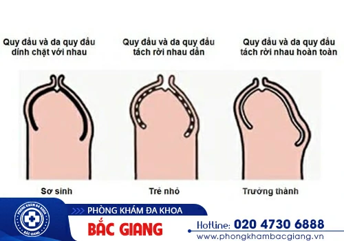 Bị dính bao quy đầu phải làm sao? Hướng xử lý hiệu quả, kịp thời