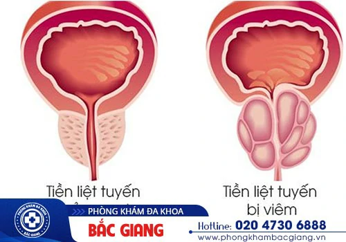 Dương vật chảy mủ nguyên nhân do đâu?