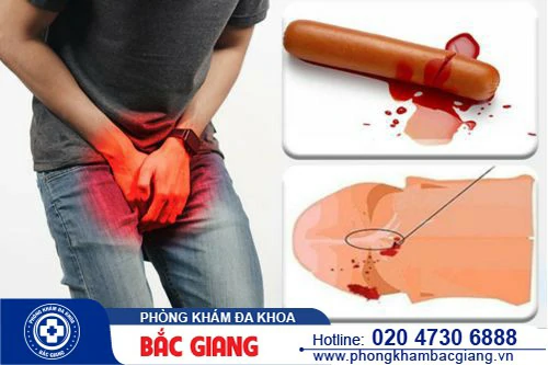 Dương vật chảy máu do đâu? Điều trị cách nào hiệu quả?