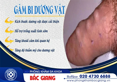 Gắn bi dương vật là gì? Có tác dụng gì?
