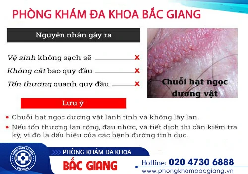 Nam giới mắc hạt ngọc dương vật có nguy hiểm không?
