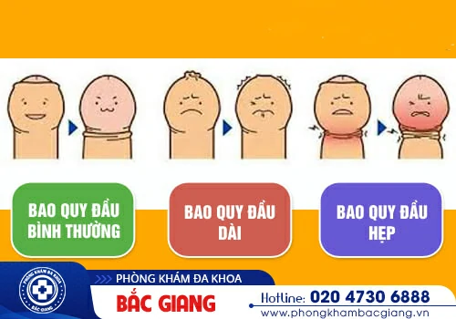 Hẹp bao quy đầu và những vấn đề xoay quanh nam giới cần biết