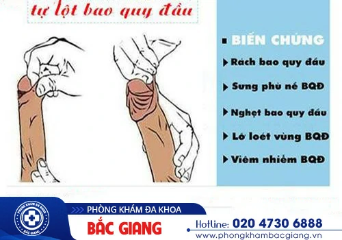 Tại sao nam giới cần lột bao quy đầu? Lột bao quy đầu như thế nào an toàn?