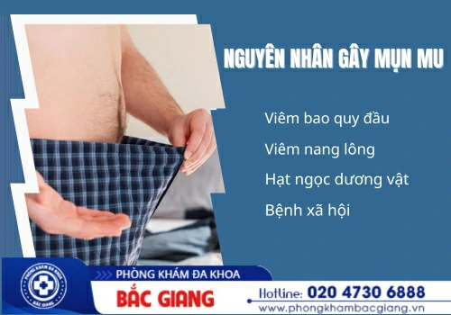 Nam giới cần cảnh giác khi xuất hiện mụn mu