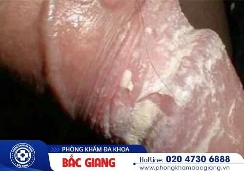 Nấm dương vật có nguy hiểm không? Biểu hiện, Nguyên nhân và Địa chỉ điều trị