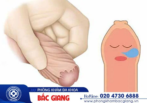 Bị hẹp bao quy đầu có nguy hiểm không?