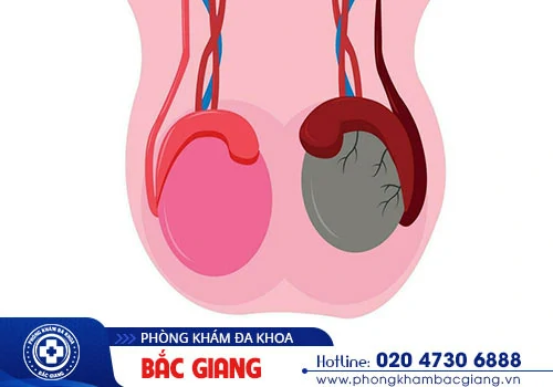 Nam giới không nên chủ quan khi bị sưng tinh hoàn?
