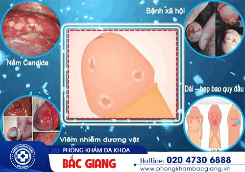 Ngứa bao quy đầu - Triệu chứng tiết lộ các bệnh lý nam khoa nguy hiểm
