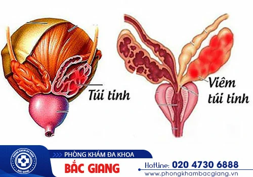 nguyen-nhan-xuat-tinh-bi-von-cuc