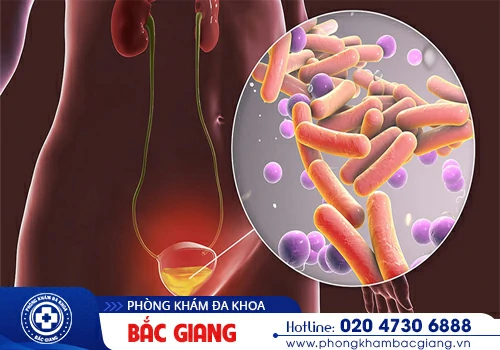 Dấu hiệu nhận biết sớm nhiễm trùng tiểu, cảnh giác với những biến chứng liên quan