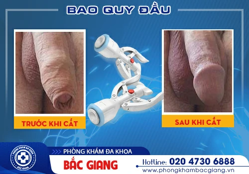 Tách dính bao quy đầu là giải pháp an toàn và hiệu quả