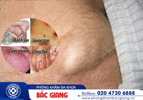 Nổi hạch vùng kín nam giới - Dấu hiệu cảnh báo bệnh lý nguy hiểm