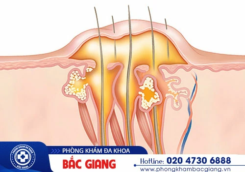 Nổi mụn ở háng nguyên nhân do đâu? Có nguy hiểm không?