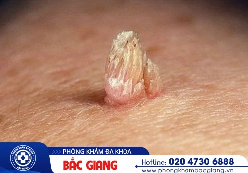 Nổi mụn ở háng nguyên nhân do đâu? Có nguy hiểm không?