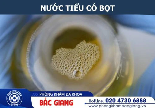 Nước Tiểu Có Bọt – Dấu Hiệu Cảnh Báo Bệnh Lý Hay Chỉ Là Hiện Tượng Bình Thường?