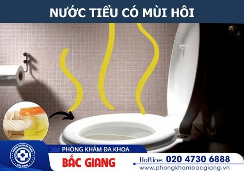 Nước Tiểu Có Mùi Hôi – Hiện Tượng Bình Thường Hay Dấu Hiệu Bệnh Lý Nguy Hiểm?
