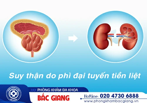 Tổng quan những kiến thức quan trọng về phì đại tuyến tiền liệt
