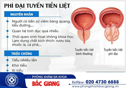 Tổng quan những kiến thức quan trọng về phì đại tuyến tiền liệt