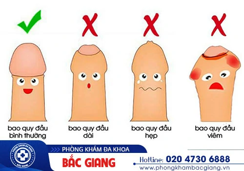 Bệnh bao quy đầu cũng là yếu tố tác động đến kích thước dương vật
