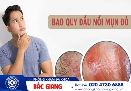 Giải đáp tình trạng bao quy đầu nổi đỏ cùng chuyên gia - Hướng khắc phục hiệu quả