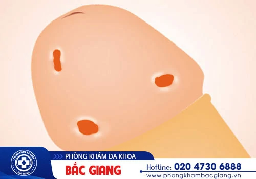 Giải đáp tình trạng bao quy đầu nổi đỏ cùng chuyên gia - Hướng khắc phục hiệu quả