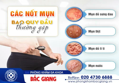 Quy đầu nổi mụn không đơn thuần do thói quen sinh hoạt