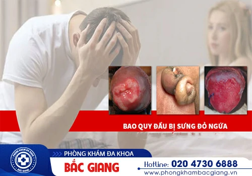 Sưng đỏ quy đầu là bệnh gì? Nguyên nhân và cách khắc phục