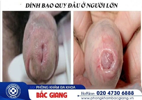 Tách dính bao quy đầu là giải pháp an toàn và hiệu quả