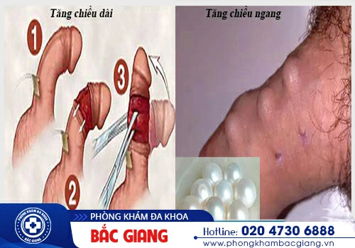Làm tăng kích thước dương vật tại nhà thế nào?
