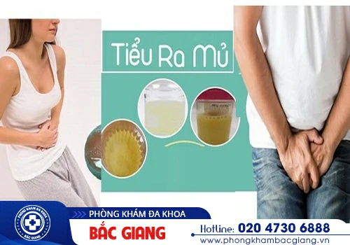Tiểu có mủ - Hiện tượng nam giới hết sức lưu ý