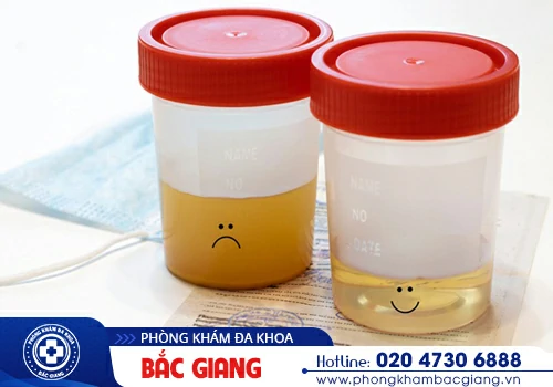 Nước tiểu đục - Dấu hiệu xấu đối với đường tiết niệu của bạn